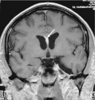 Abbildung 1: Neurosarkoidose