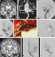Abbildung 5a-i: Aneurysma per magna