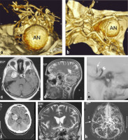 Abbildung 7a-h: Riesenaneurysma