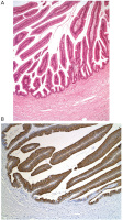 Abbildung 1a-b: Neoplasie