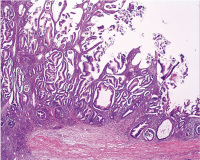 Abbildung 4: Neoplasie