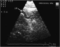 Figure 1: Koronarfistel