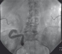 Abbildung 1a: Ureteropyelographie