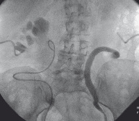 Abbildung 1b: Ureteropyelographie