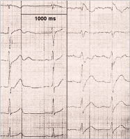 Abbildung 2: ECG leads