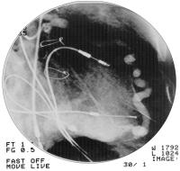 Figure 3: Koronarfistel