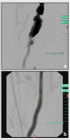 Abbildung 6a-b: Femoropoplitealvenenbypass