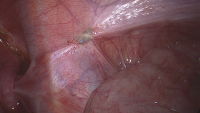 Abbildung 1: Peritoneale Endometriose