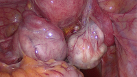 Abbildung 2: Ovarielle Endometriose