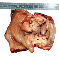 Abbildung 3: Darmendometriose