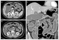 Abbildung 1a-c: Morbus Crohn