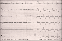 Abbildung 1: EKG