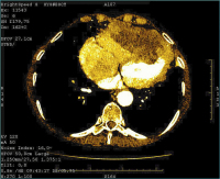 Abbildung 7: Thorax-CT