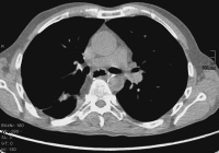 Abbildung 3: Low-dose-CT
