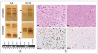 Figure 1a-c: Molecular markers in glioma