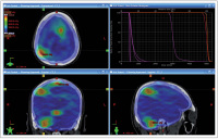 Figure 1: Brain Radiotherapy