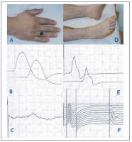 Figure 2: Cisplatinum neuropathy
