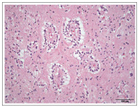 Figure 4: Brain Tumour  