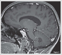 Figure 3: Brain Tumour