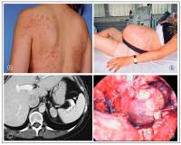 Abbildung 1a-d: Cushing-Syndrom