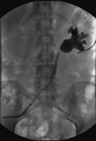 Abbildung 3: Nephrostomie 