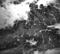 Abbildung 3: Barrett-Adenokarzinom