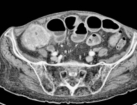 Abbildung 2a: Abdomen - Tumor