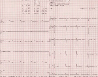 Abbildung 1: EKG