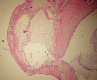 Abbildung 1: Appendix - Neoplasma