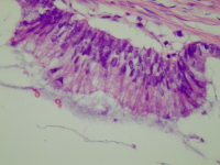 Abbildung 2: Appendix - Neoplasma