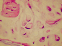 Abbildung 5: Pseudomyxoma peritonei