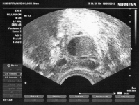 Abbildung 1: Endometriosezysten