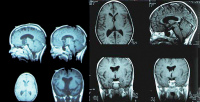 Abbildung 2: Gelastische Epilepsie