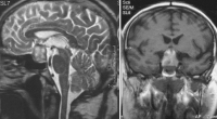 Abbildung 1: Hypophysenapoplexie