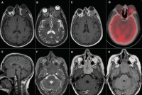 Figure 1a-h: Brain - MRI