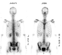 Figure 4: Skeletal involvement