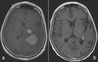 Figure 1a-b: Gadolinium Injection