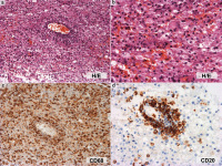 Figure 2a-d: Brain biopsy
