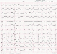 Abbildung 1: STEMI-Hebung