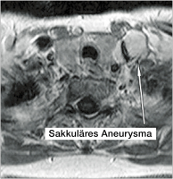 Abbildung 3: Aneurysma