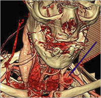Abbildung 5: Sakkiformes Aneurysma