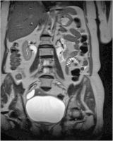 Abbildung 1: Arteria-spinalis-anterior-Syndrom