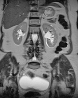 Abbildung 2: Arteria-spinalis-anterior-Syndrom