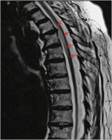 Abbildung 3: Arteria-spinalis-anterior-Syndrom
