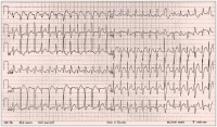 Abbildung 1: EKG