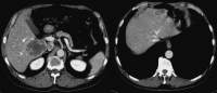 Abbildung 2: Primrtumor - Leber
