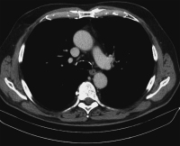 Abbildung 2a: Thorax-CT