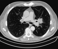 Abbildung 2b: Thorax-CT