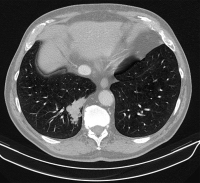 Abbildung 2c : Thorax-CT