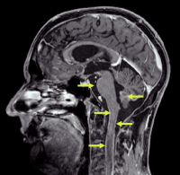 Figure 1: Glioblastoma